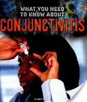 Čo potrebujete vedieť o zápale spojiviek - What You Need to Know about Conjunctivitis