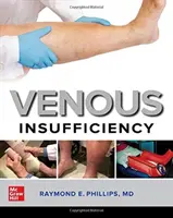 Žilová nedostatočnosť - Venous Insufficiency