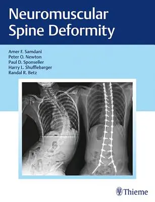 Neuromuskulárna deformita chrbtice - Neuromuscular Spine Deformity