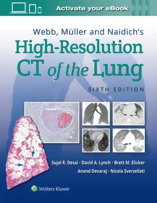Webb, Mller a Naidich - CT pľúc s vysokým rozlíšením - Webb, Mller and Naidich's High-Resolution CT of the Lung