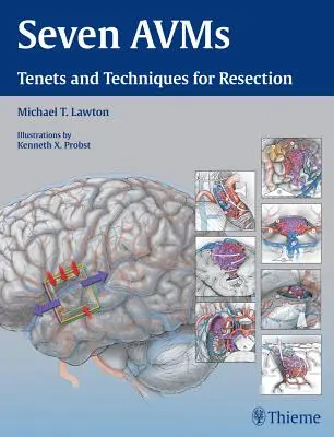 Sedem Avms: Desatoro a techniky resekcie - Seven Avms: Tenets and Techniques for Resection