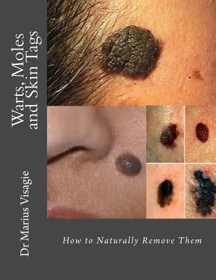Bradavice, materské znamienka a kožné značky: Ako ich prirodzene odstrániť? - Warts, Moles and Skin Tags: How to Naturally Remove Them