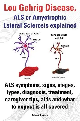 Vysvetlenie Lou Gehrigovej choroby, ALS alebo amyotrofickej laterálnej sklerózy. Príznaky ALS, príznaky, štádiá, typy, diagnostika, liečba, tipy pre opatrovateľov, AIDS a - Lou Gehrig Disease, ALS or Amyotrophic Lateral Sclerosis Explained. ALS Symptoms, Signs, Stages, Types, Diagnosis, Treatment, Caregiver Tips, AIDS and