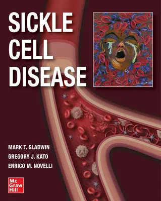 Choroba srpkovitých buniek - Sickle Cell Disease