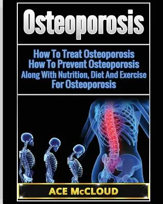 Osteoporóza: Ako liečiť osteoporózu: Ako predchádzať osteoporóze: Ako na osteoporózu: Spolu s výživou, diétou a cvičením na osteoporózu - Osteoporosis: How To Treat Osteoporosis: How To Prevent Osteoporosis: Along With Nutrition, Diet And Exercise For Osteoporosis