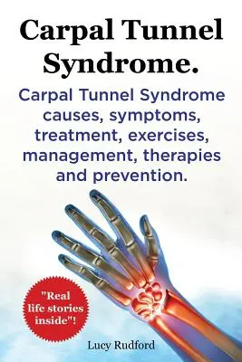 Syndróm karpálneho tunela, Cts. Syndróm karpálneho tunela Cts Príčiny, príznaky, liečba, cvičenia, manažment, terapie a prevencia. - Carpal Tunnel Syndrome, Cts. Carpal Tunnel Syndrome Cts Causes, Symptoms, Treatment, Exercises, Management, Therapies and Prevention.