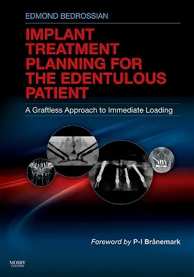 Plánovanie liečby implantátmi pre bezzubých pacientov: Beztransplantačný prístup k okamžitému zaťaženiu - Implant Treatment Planning for the Edentulous Patient: A Graftless Approach to Immediate Loading