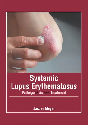Systémový lupus erythematosus: Patogenéza a liečba - Systemic Lupus Erythematosus: Pathogenesis and Treatment