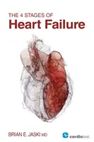 4 štádiá zlyhania srdca - The 4 Stages of Heart Failure
