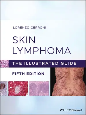 Lymfóm kože: Ilustrovaný sprievodca - Skin Lymphoma: The Illustrated Guide