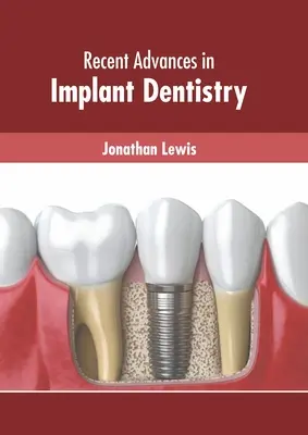 Najnovšie pokroky v zubnej implantológii - Recent Advances in Implant Dentistry