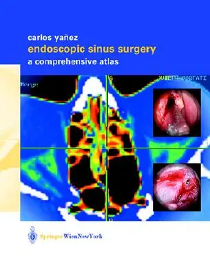 Endoskopická chirurgia prínosových dutín: Komplexný atlas - Endoscopic Sinus Surgery: A Comprehensive Atlas