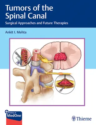 Nádory chrbticového kanála: Chirurgické prístupy a budúce terapie - Tumors of the Spinal Canal: Surgical Approaches and Future Therapies