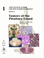 Nádory hypofýzy - Tumors of the Pituitary Gland