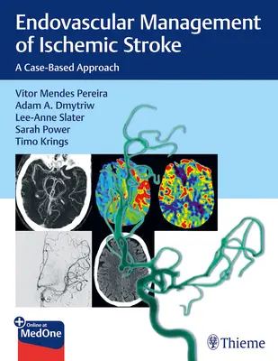 Endovaskulárna liečba ischemickej cievnej mozgovej príhody: Prístup založený na konkrétnych prípadoch - Endovascular Management of Ischemic Stroke: A Case-Based Approach