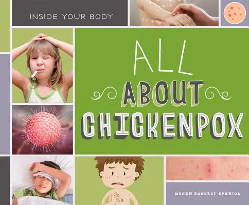 Všetko o ovčích kiahňach - All about Chickenpox