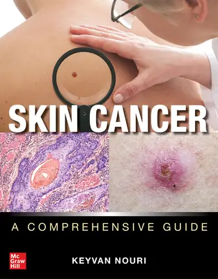 Rakovina kože: Rýchla rakovina: komplexný sprievodca - Skin Cancer: A Comprehensive Guide