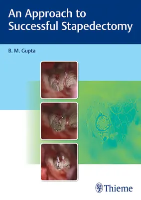 Prístup k úspešnej stapedektómii - An Approach to Successful Stapedectomy