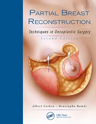 Čiastočná rekonštrukcia prsníka: Techniky v onkoplastickej chirurgii - Partial Breast Reconstruction: Techniques in Oncoplastic Surgery