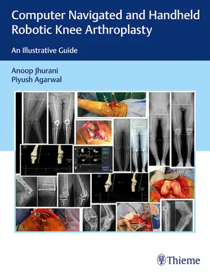 Počítačom navigovaná a ručná robotická artroplastika kolena: Ilustračný sprievodca - Computer Navigated and Handheld Robotic Knee Arthroplasty: An Illustrative Guide