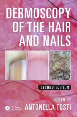 Dermoskopia vlasov a nechtov - Dermoscopy of the Hair and Nails