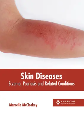Kožné choroby: Ekzémy, psoriáza a súvisiace ochorenia - Skin Diseases: Eczema, Psoriasis and Related Conditions