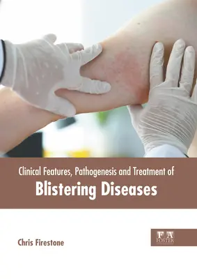 Klinické vlastnosti, patogenéza a liečba pľuzgierovitých ochorení - Clinical Features, Pathogenesis and Treatment of Blistering Diseases