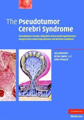 Syndróm pseudotumor cerebri - The Pseudotumor Cerebri Syndrome