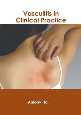 Vaskulitída v klinickej praxi - Vasculitis in Clinical Practice
