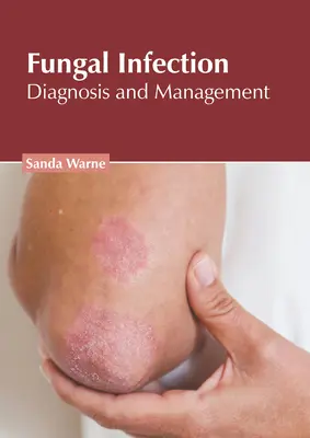 Hubové infekcie: Diagnostika a manažment - Fungal Infection: Diagnosis and Management