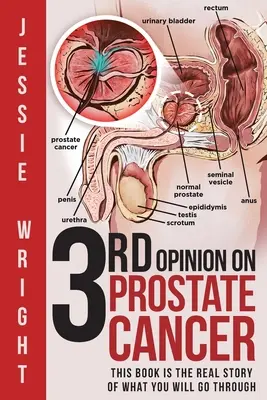 3. Názor na rakovinu prostaty - 3rd Opinion on Prostate Cancer