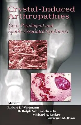 Artropatie vyvolané kryštálmi: Dna, pseudodna a syndrómy spojené s apatitom - Crystal-Induced Arthropathies: Gout, Pseudogout and Apatite-Associated Syndromes