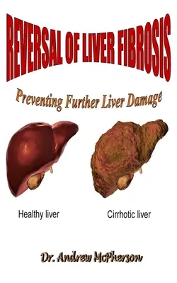 Reverzibilita fibrózy pečene: Prevencia ďalšieho poškodenia pečene - Reversal of Liver Fibrosis: Preventing Further Liver Damage