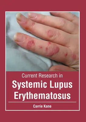 Súčasný výskum systémového lupus erythematosus - Current Research in Systemic Lupus Erythematosus
