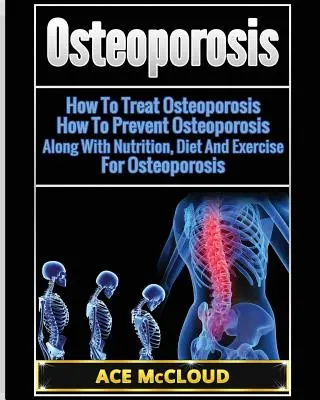 Osteoporóza: Ako liečiť osteoporózu: Ako predchádzať osteoporóze: Výživa, diéta a cvičenie pri osteoporóze - Osteoporosis: How To Treat Osteoporosis: How To Prevent Osteoporosis: Along With Nutrition, Diet And Exercise For Osteoporosis