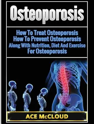 Osteoporóza: Ako liečiť osteoporózu: Ako predchádzať osteoporóze: Výživa, diéta a cvičenie pri osteoporóze - Osteoporosis: How To Treat Osteoporosis: How To Prevent Osteoporosis: Along With Nutrition, Diet And Exercise For Osteoporosis
