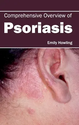 Komplexný prehľad psoriázy - Comprehensive Overview of Psoriasis