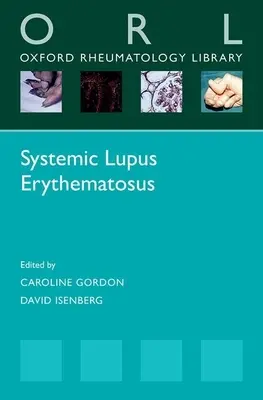 Systémový lupus erythematosus - Systemic Lupus Erythematosus