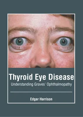 Očné ochorenie štítnej žľazy: Pochopenie Gravesovej oftalmopatie - Thyroid Eye Disease: Understanding Graves' Ophthalmopathy