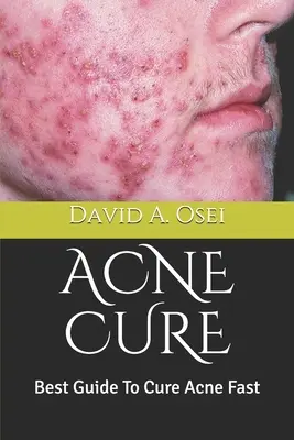 Liečba akné: Najlepší sprievodca na rýchle vyliečenie akné - Acne Cure: Best Guide To Cure Acne Fast