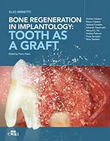 Regenerácia kostí v implantológii - zub ako štep - Bone regeneration in implantology - tooth as a graft