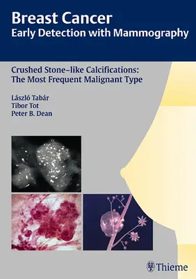 Rakovina prsníka: Včasná detekcia pomocou mamografie: Rozdrvené kalcifikáty podobné kameňom: Najčastejší malígny typ [s CDROM] - Breast Cancer: Early Detection with Mammography: Crushed Stone-Like Calcifications: The Most Frequent Malignant Type [With CDROM]