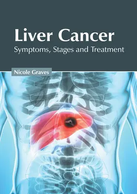Rakovina pečene: Príznaky, štádiá a liečba - Liver Cancer: Symptoms, Stages and Treatment