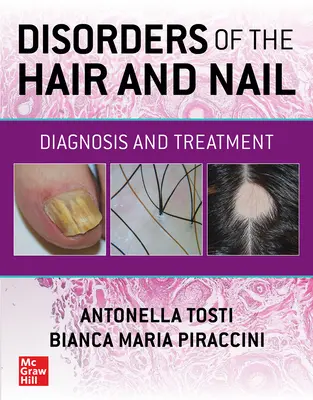 Poruchy vlasov a nechtov: Diagnostika a liečba - Disorders of the Hair and Nail: Diagnosis and Treatment