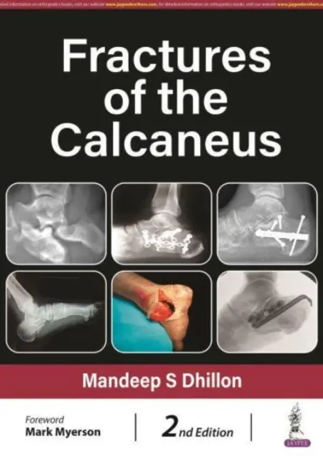 Zlomeniny pätovej kosti - Fractures of the Calcaneus
